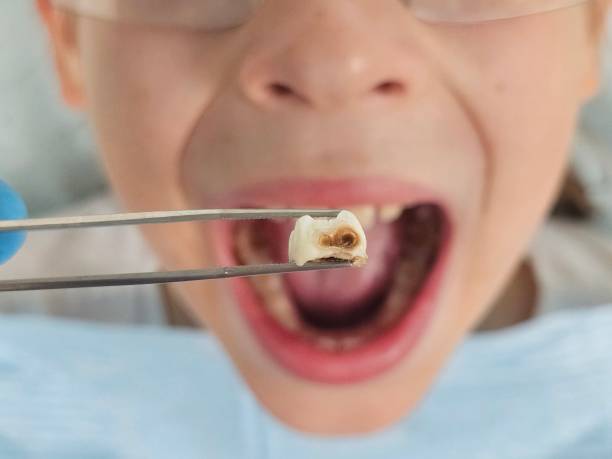 Best Emergency Dental Care for Broken or Chipped Teeth in Le Sueur, MN