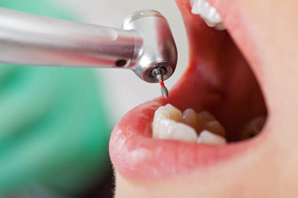 Best Emergency Tooth Extraction in Le Sueur, MN